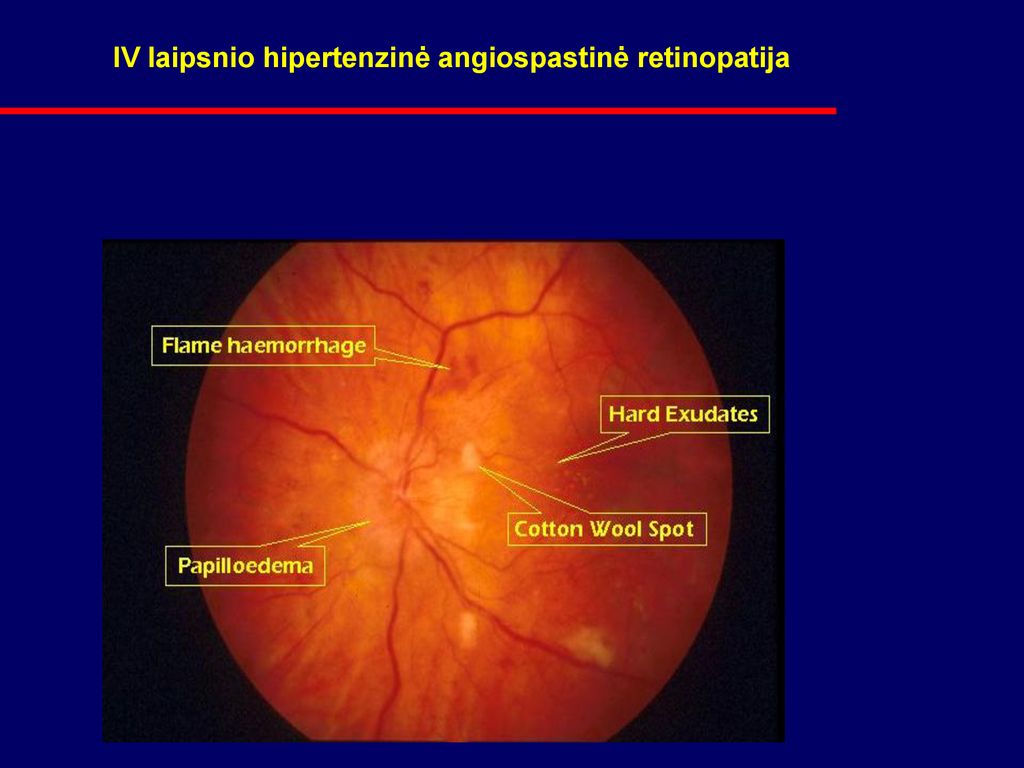 retinopatija, hipertenzija)
